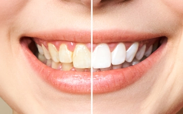 Clareamento Dental Caseiro Com Moldeira