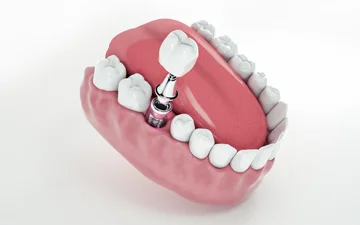 Implante Dentário