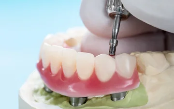 Overdenture